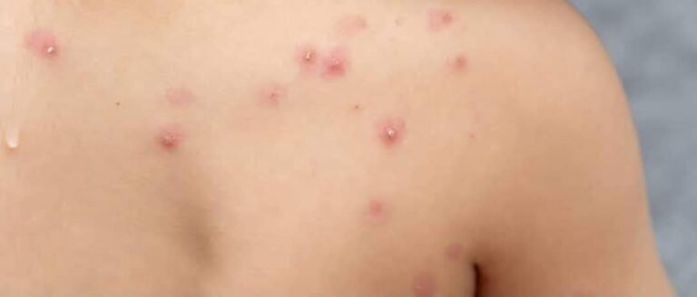 Salud confirmó que el caso de Viruela del Mono que estuvo en Madero dio POSITIVO*